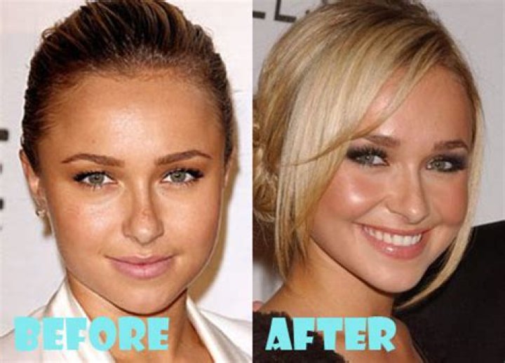 Hayden Panettiere Plastic Surgery Before and After
