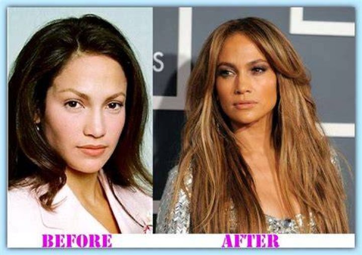 Jennifer Lopez Plastic Surgery Before and After