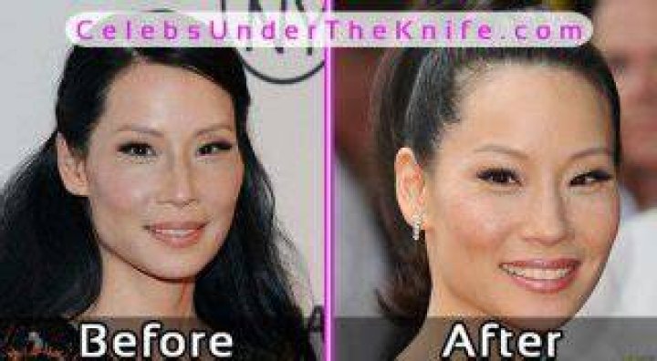 Lucy Liu Plastic Surgery Before and After