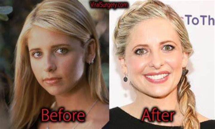 Sarah Michelle Gellar Plastic Surgery Before and After